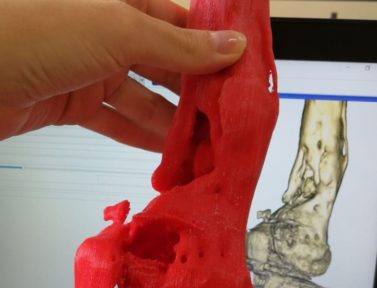 FabLab imprime hueso 3D para estudiante accidentado